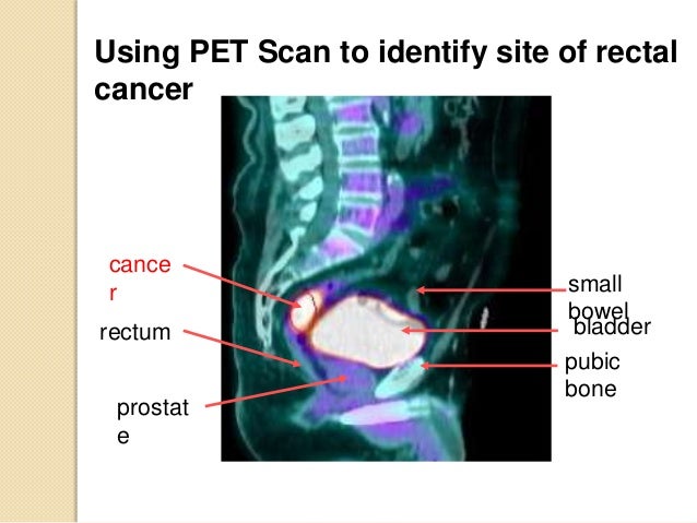 pet scan for anal cancer Thai ladyboy by milker xxx